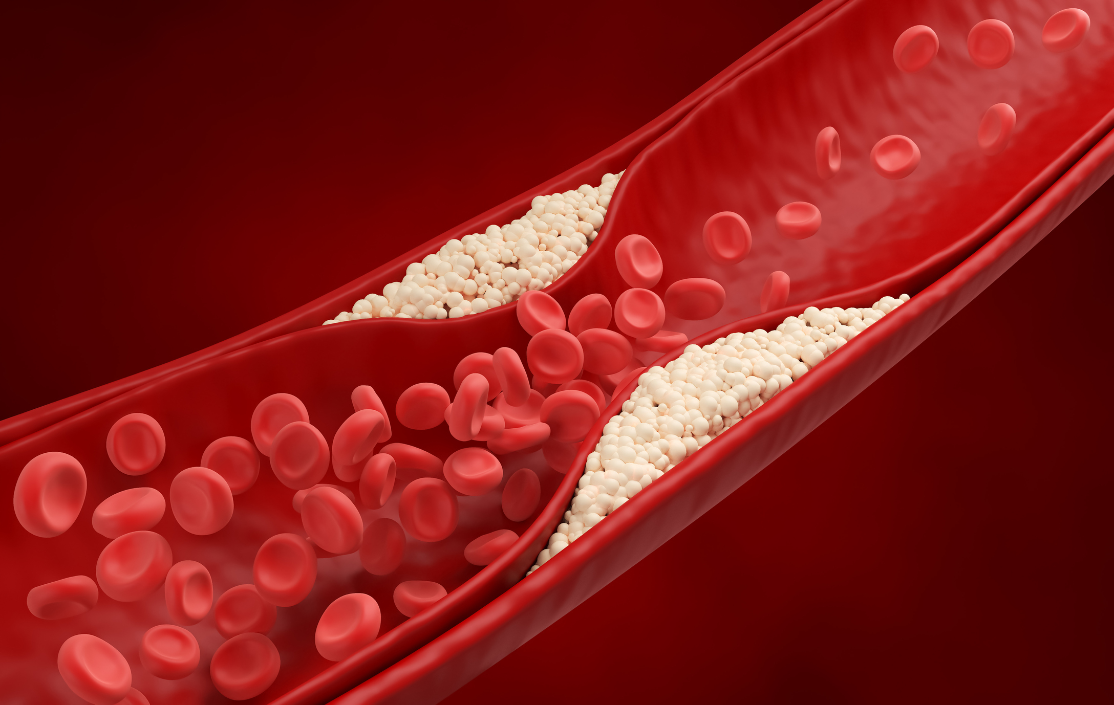 This image is a detailed, digitally rendered illustration depicting a blockage within a blood vessel. The vessel itself is represented as a smooth, glossy, reddish-brown tube, curving slightly and filling the frame. Inside the vessel, numerous red blood cells, shaped like biconcave discs, are visible, flowing around a significant obstruction. This obstruction appears as a large, irregular accumulation of small, pale beige or off-white spherical particles, resembling cholesterol plaques or a blood clot. The particles are densely packed, forming a substantial mass that significantly narrows the vessel's lumen, impeding the flow of blood. The blockage isn't a complete occlusion, as some red blood cells are still attempting to navigate around it, but the flow is clearly restricted. The background is a solid, deep red, enhancing the contrast and focusing attention on the vessel and its contents. The lighting is soft and diffused, creating highlights on the vessel walls and the surfaces of the red blood cells, giving the image a realistic, almost microscopic appearance. The overall impression is one of cardiovascular disease, specifically atherosclerosis or thrombosis, illustrating the dangers of restricted blood flow within the circulatory system. The image is likely intended for educational or medical purposes, demonstrating the physical impact of such conditions.